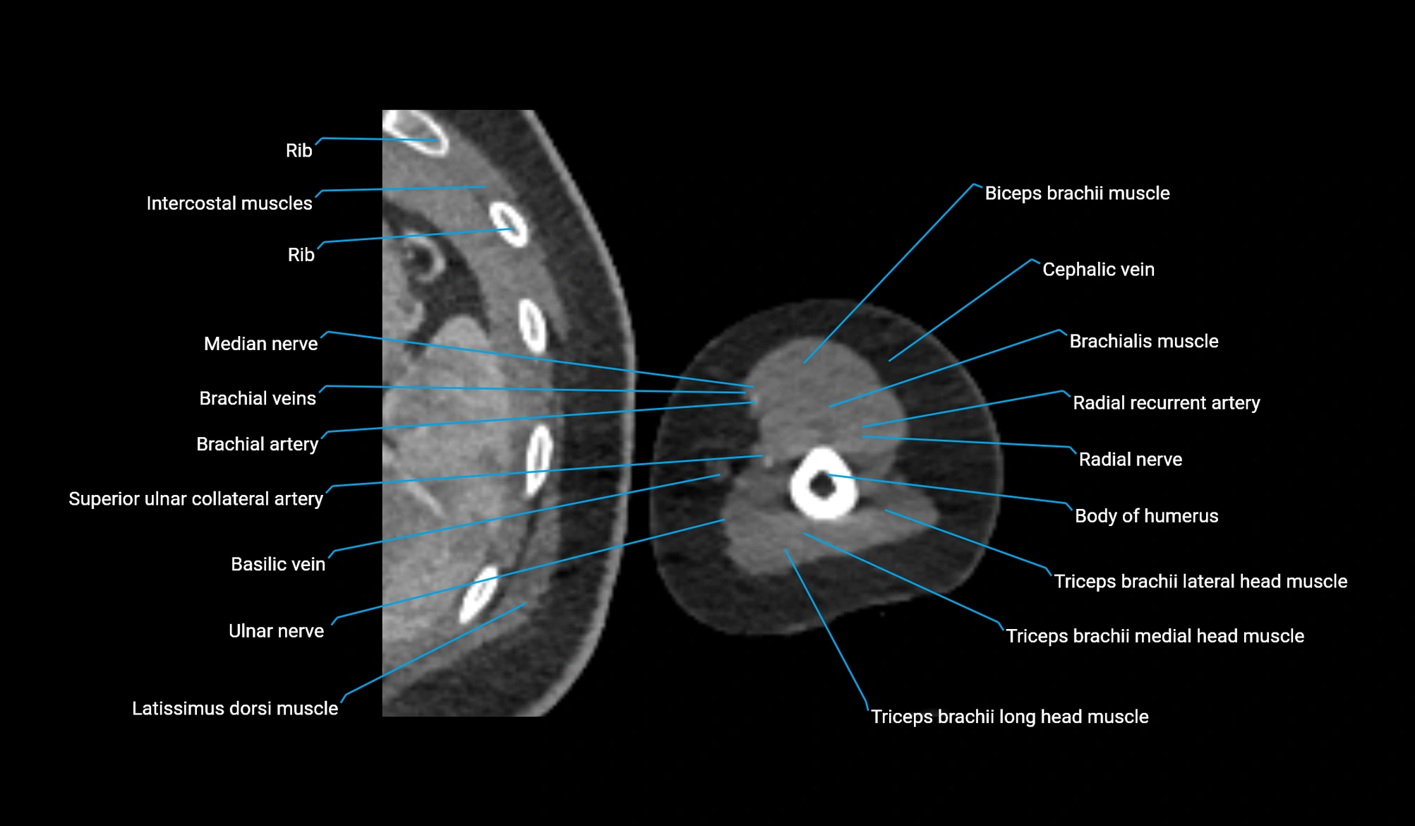 CT upper arm axial  cross sectional anatomy labelled radiology image -00306.webp